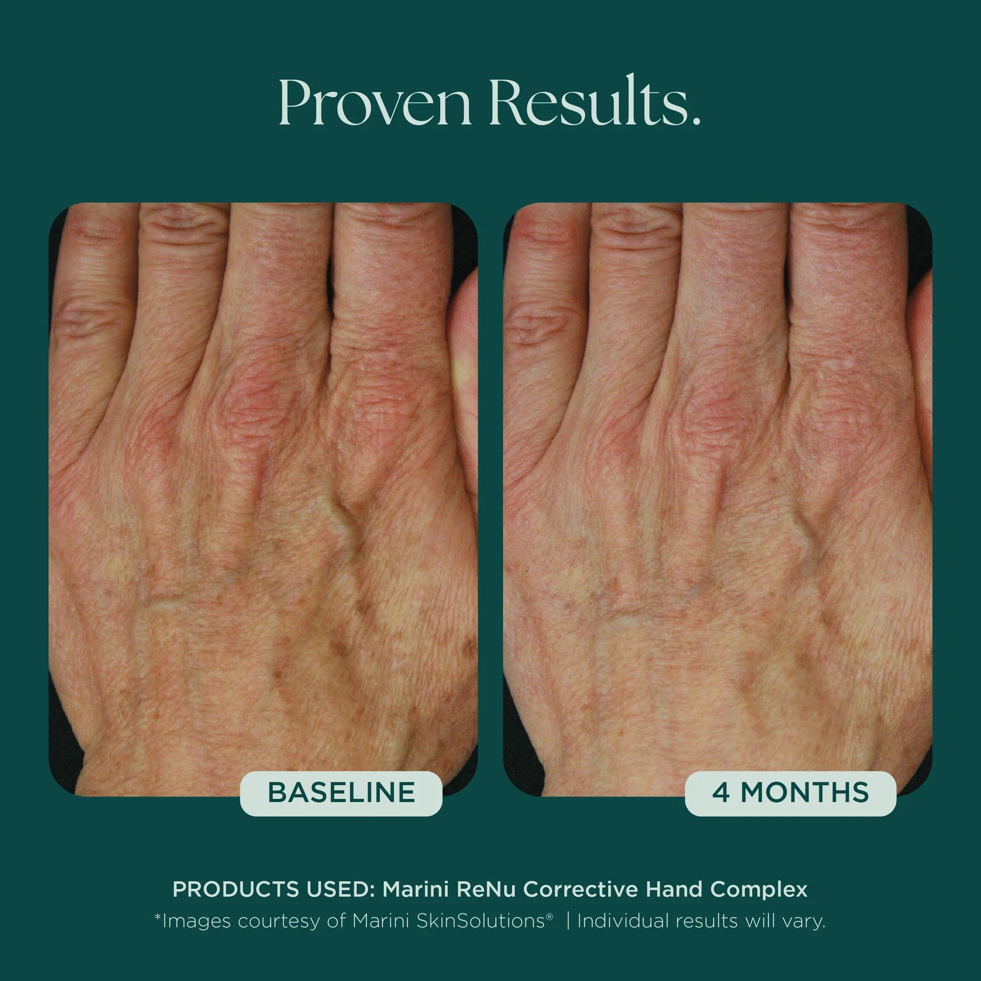 Marini ReNu Corrective Hand Complex