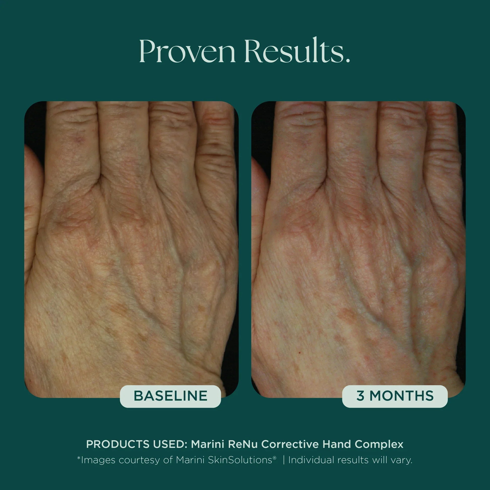 Marini ReNu Corrective Hand Complex