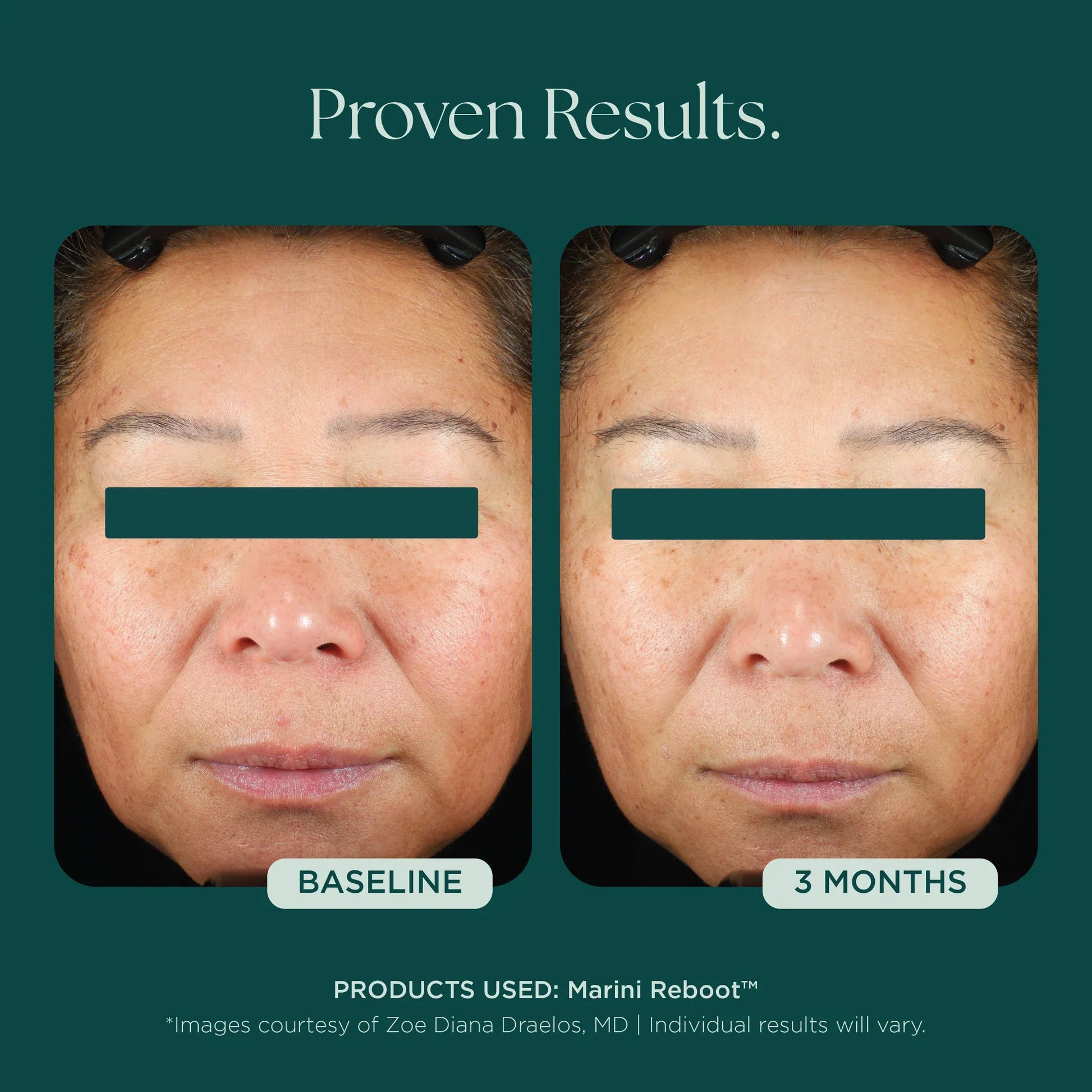 Marini Reboot® PDRN Face Serum
