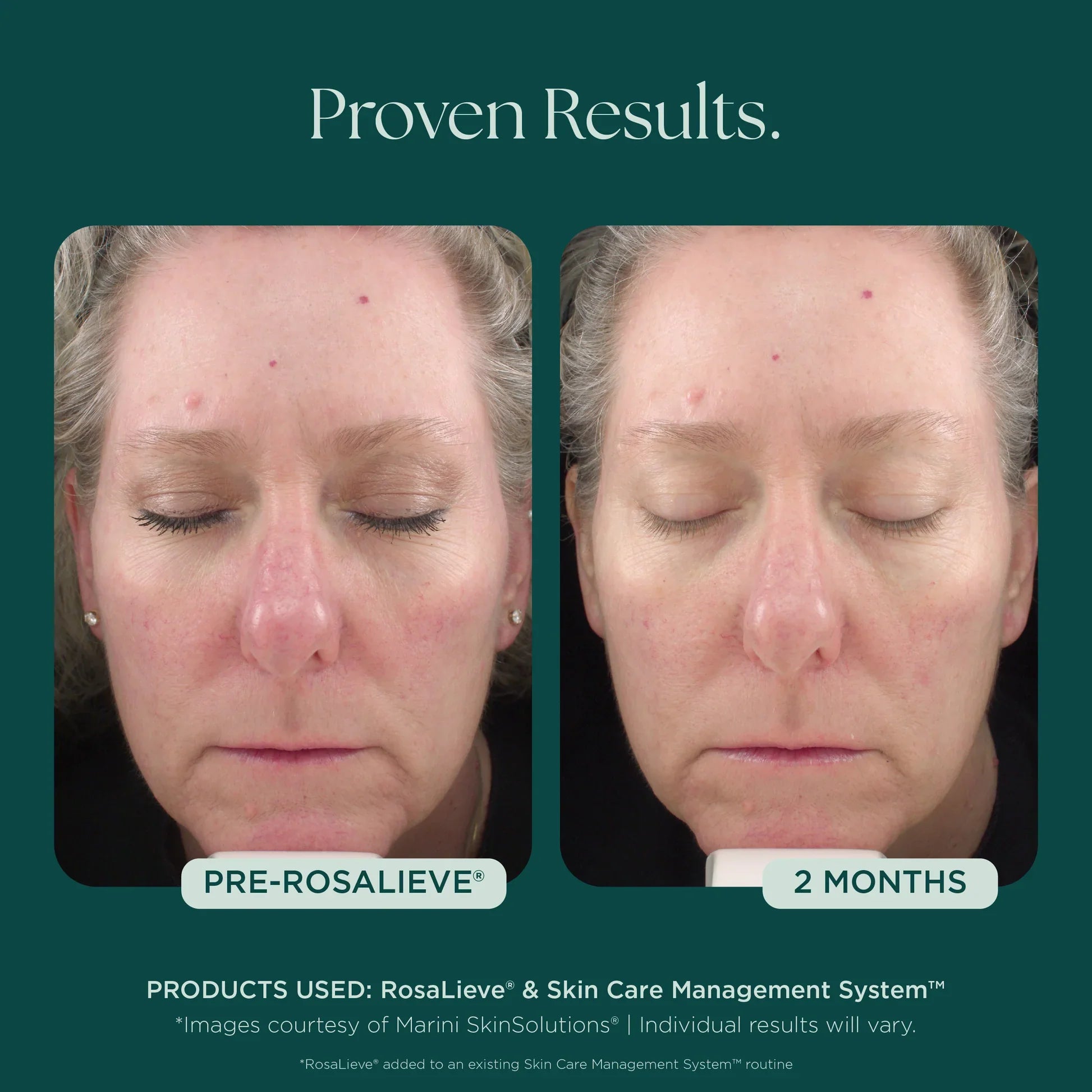 RosaLieve® Redness Reducing Complex