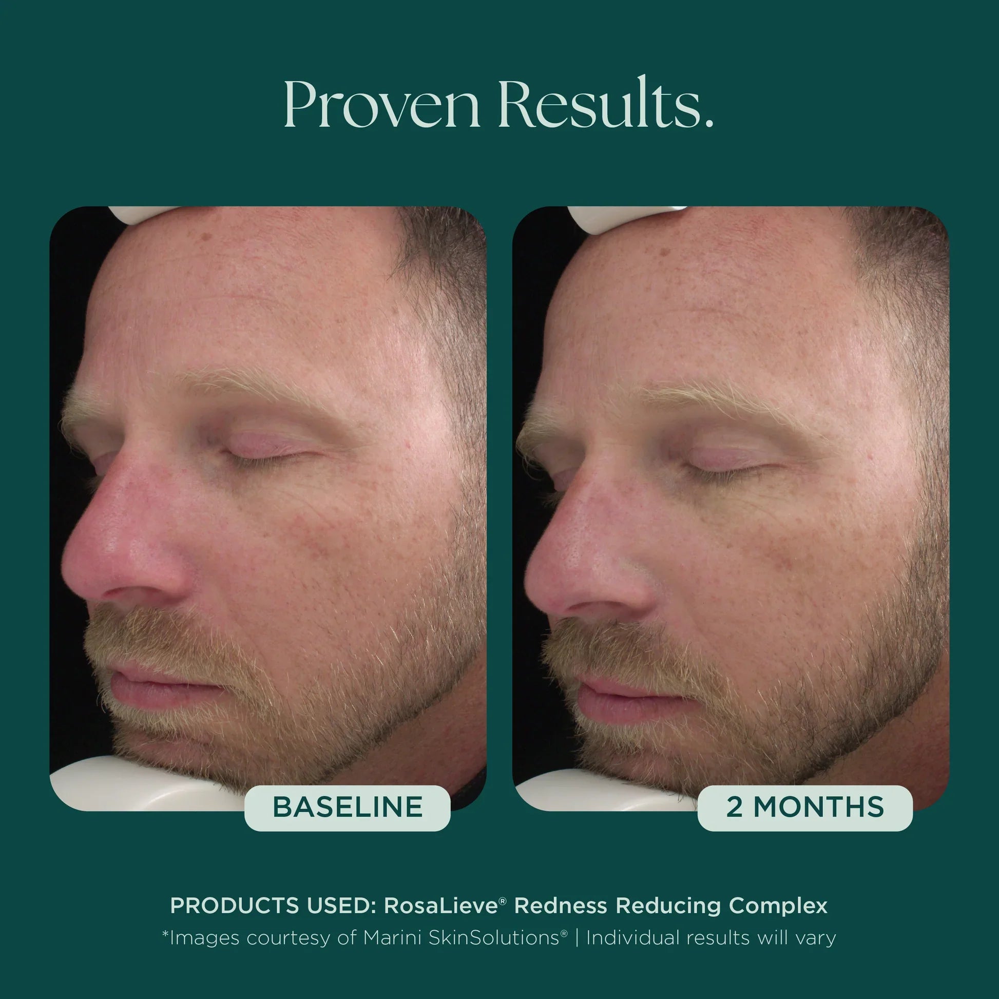 RosaLieve® Redness Reducing Complex