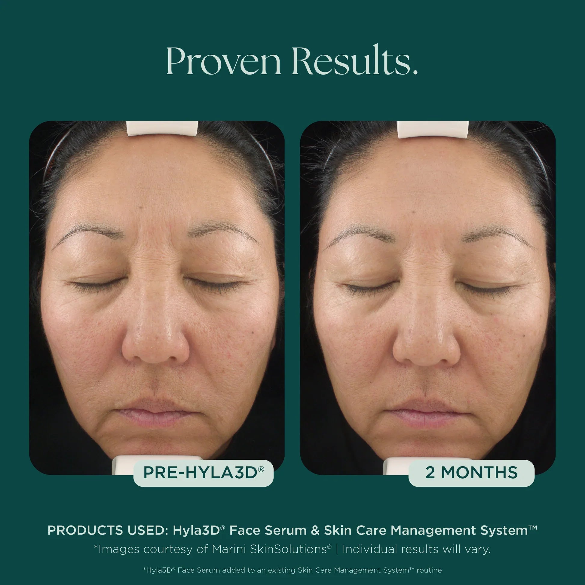 Hyla3D® Face Serum Hyaluronic Acid Complex