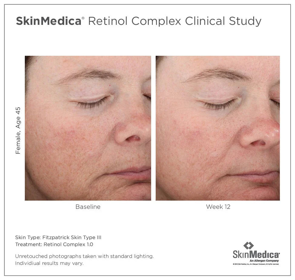 SkinMedica Age Defense Retinol Complex 1.0